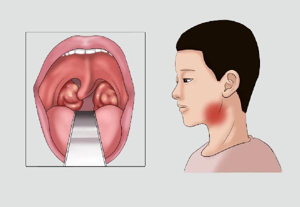 是药三分毒 白叟用药须留意4点